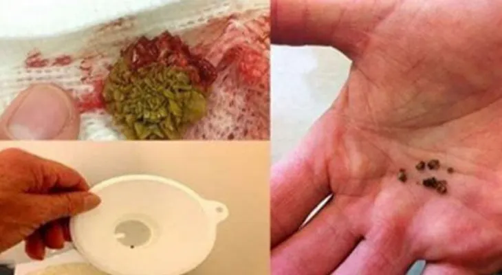 Elimina para siempre las piedras del riñón con este increíble remedio