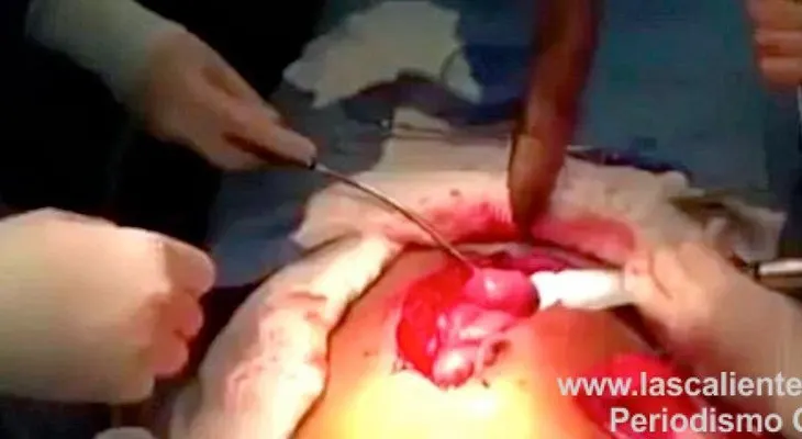 Sacan un pez vivo intestino de un hombre (Video)