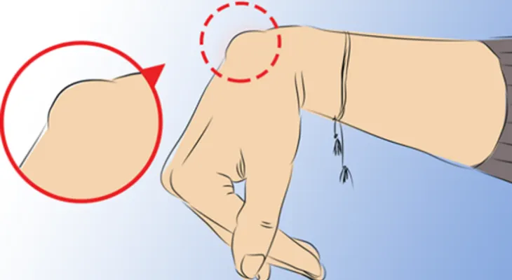 Si esto te ocurre en la muñeca de tu mano, llama urgente un médico. EL MOTIVO ES DE GRAVEDAD !!!