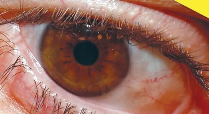La retinopatía diabética es la segunda causa de ceguera