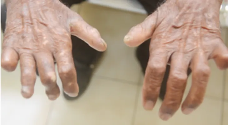 Cura de la lepra es un desafío por cumplir