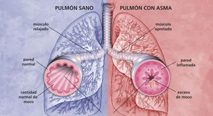 Para el asma, bronquitis, tos y enfermedades pulmonares