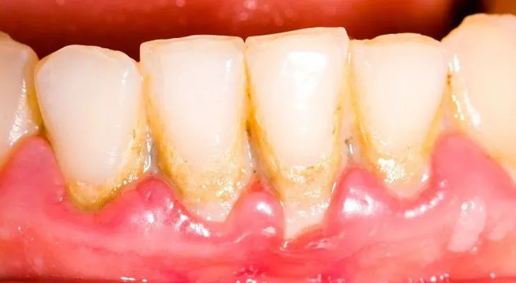 Como eliminar la placa dental con remedios naturales