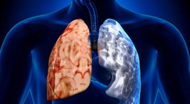 El desarrollo de los pulmones en los primeros años, clave para evitar EPOC