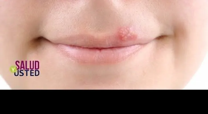 Como frenar un Herpes Labial en una sola noche con este sencillo Truco Natural