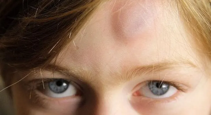 9 soluciones naturales para tratar los moretones