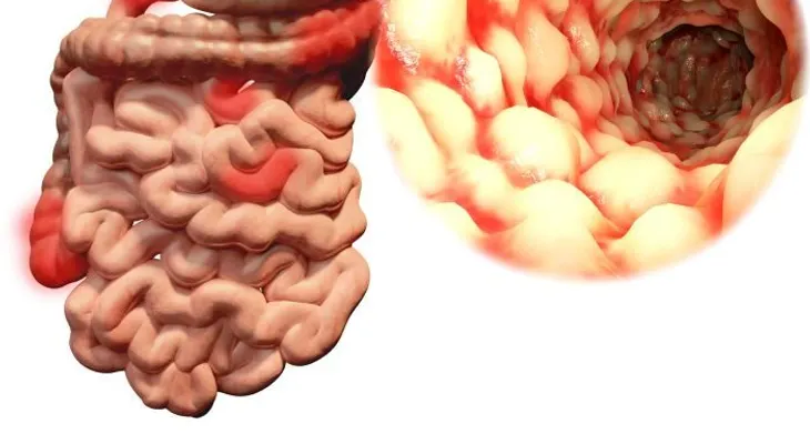 Nuevo tratamiento para enfermedad de Crohn está disponible en República Dominicana 