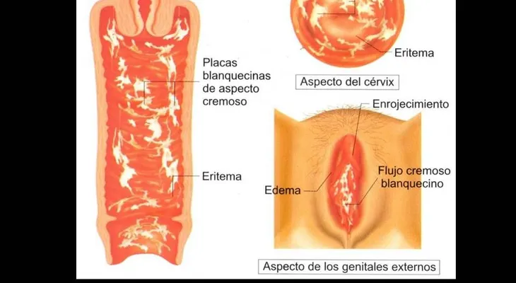Cómo deshacerse para siempre de los hongos vaginales: ANOTA