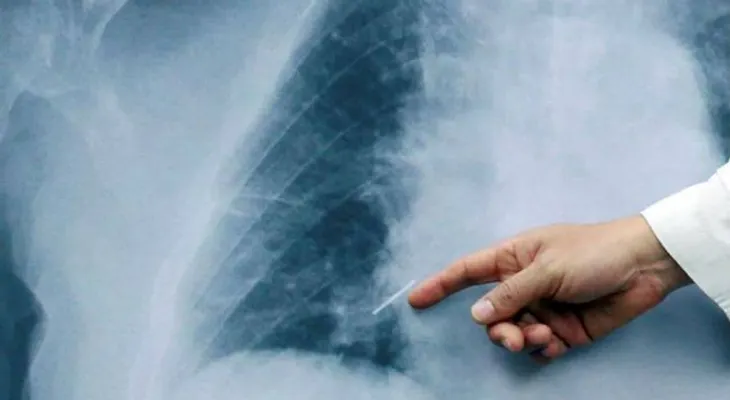  Cáncer de pulmón es uno de los más frecuentes en hombres 