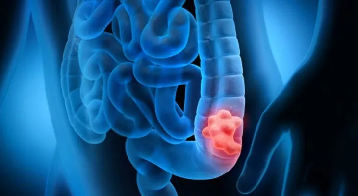 Importancia de realizar pruebas genéticas en pacientes con cáncer de colón