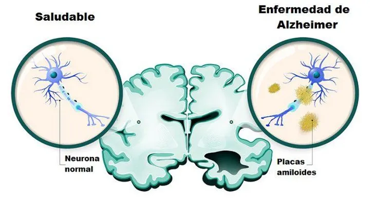 10 cosas que debes hacer para prevenir la enfermedad de Alzheimer