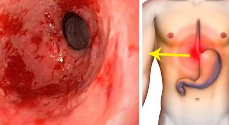 Potente remedio para eliminar la gastritis y la acidez estomacal