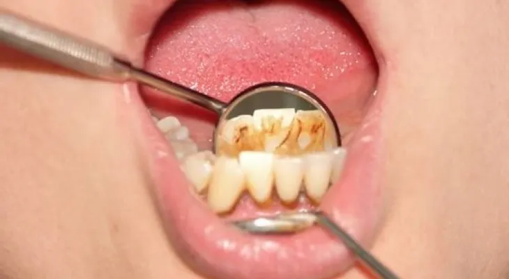 El sarro de los dientes; remedios efectivos para quitarlo
