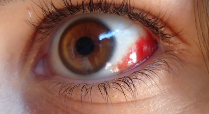 Si tiene los ojos así de rojos, sal corriendo donde un doctor: se trata de algo muy grave 