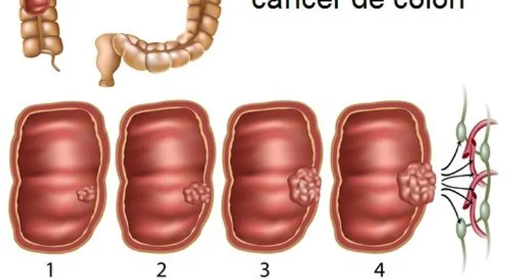 Síntomas de cáncer de colon que no debes ignorar