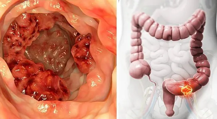 Demostrado científicamente: Este aceite destruye el 90% células cáncer de colon en 3 dí­as