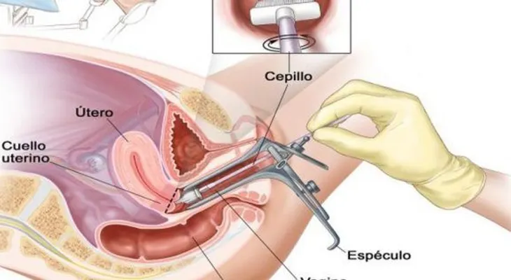Una mujer murió debido a cáncer de útero: estos son los síntomas que ignoró