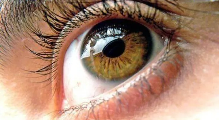 5 remedios para tratar el síndrome del ojo seco
