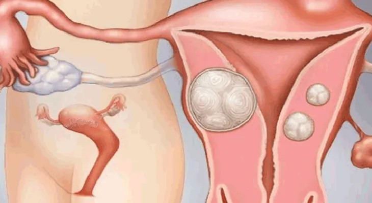 Maneras de cuidar el útero para tener mejores ciclos menstruales
