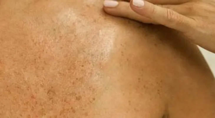 Reduce las manchas de la piel de forma segura