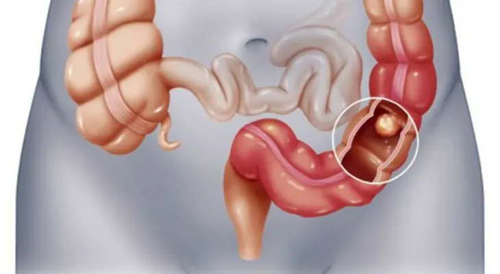 49 mil mueren al año por cáncer colorrectal en Latinoamérica 