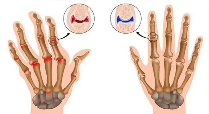 Una nueva cura para la artritis, reumatismo y problemas con articulaciones