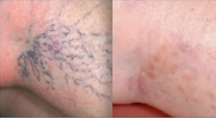 Cura las varices de tus pies con este poderoso remedio casero (VIDEO)