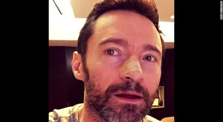 Hugh Jackman vuelve a ser intervenido por cáncer de piel