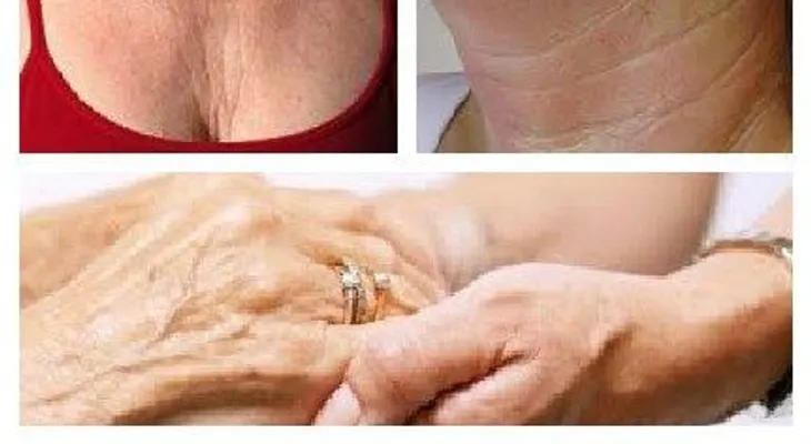 Tratamiento para prevenir arrugas en cuello y manos