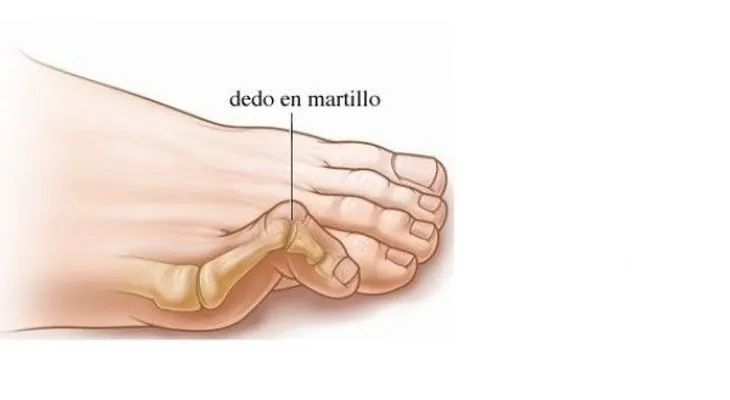 ¿Por qué duele tanto golpearse el dedito del pie?