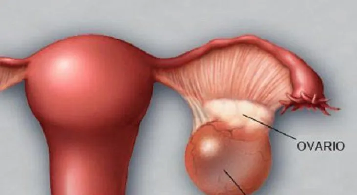 6 remedios que debes conocer para limpiar los quistes ováricos 