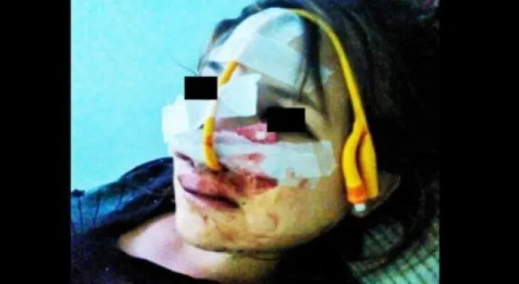 Embarazada desfigurada por su novio por abrir cuenta en Facebook