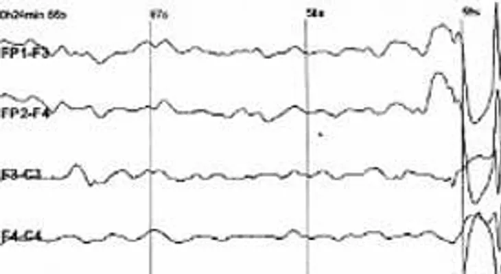 Crean un chip que podría prevenir la epilepsia  