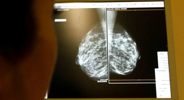 Investigadores canadienses hallan un método para impedir el cáncer de mama 