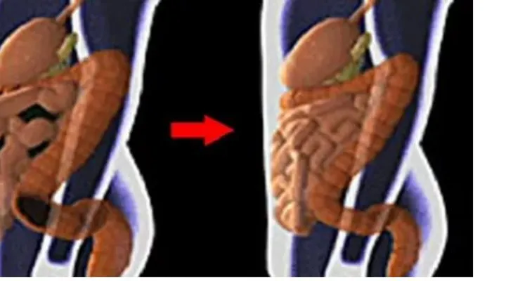 30 libras de toxinas en el colon, cómo limpiarla con dos ingredientes !!!