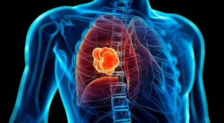 Inmunoterapia es una esperanza de vida para pacientes con cáncer de pulmón