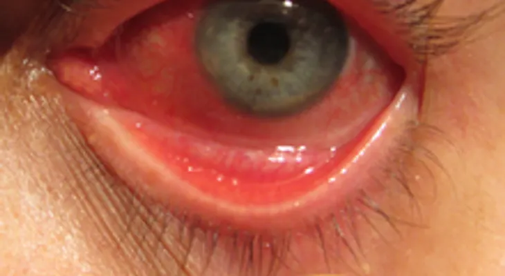 Zumo de perejil y lavados con eufrasia para la conjuntivitis