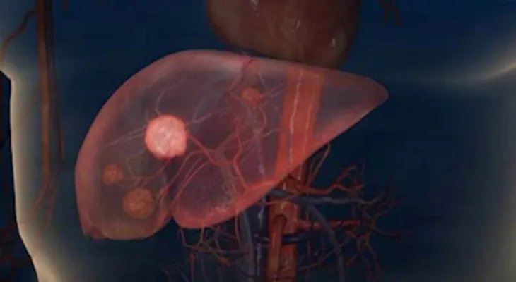 Cómo es el moderno tratamiento contra el cáncer de hígado
