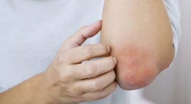 Enfermedades de piel conocida como psoriasis, provocan fuertes impactos emocionales