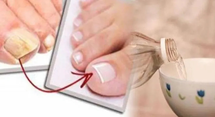 ¡Traté muchas formas para eliminar hongos de mis uñas, hasta que probé este remedio...!
