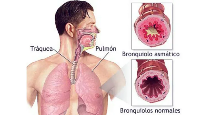 La bronquistis asmástica; síntomas y tratamiento
