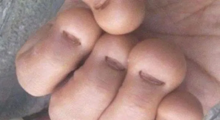 Un hombre muere de un infarto después de morderse las uñas