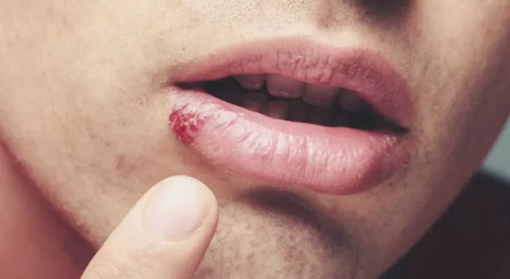 Alarma mundial: Un 67% población está contagiada de herpes