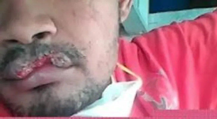 Recluso le arranca parte del labio a otro de una mordida en cárcel de Montecristi