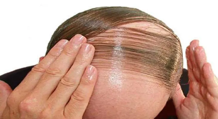 ¿Fin de la calvicie? Droga contra la artritis hace crecer el cabello
