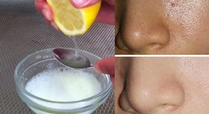 Anota: Cómo quitar TODA la grasa de la cara en 5 minutos, con solo estos 2 ingredientes!!!
