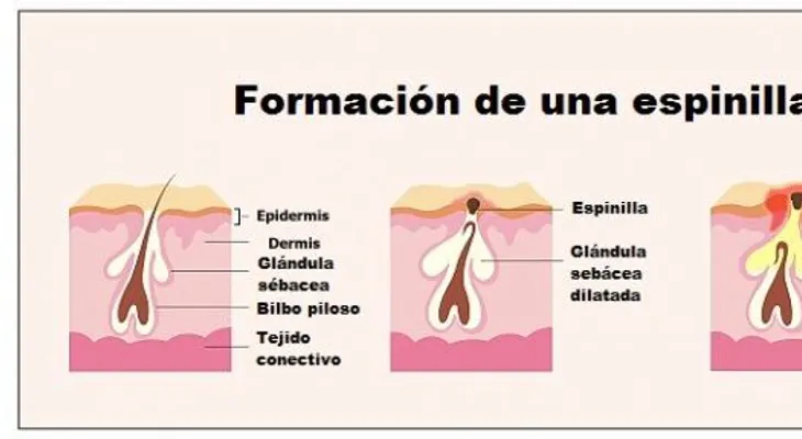 Espinillas dentro de la nariz, remedios naturales