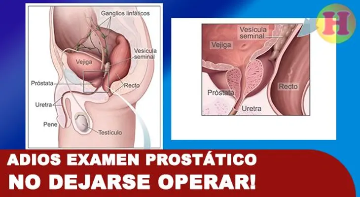 La próstata se agranda por la edad; alegan no es necesario operarla. Los limones pueden matar células cancerosas