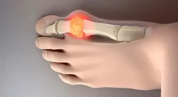 Elimina los cristales de ácido úrico de articulaciones con este simple remedio a base de pepino