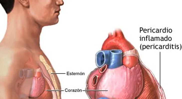 Pericarditis; causas y síntomas